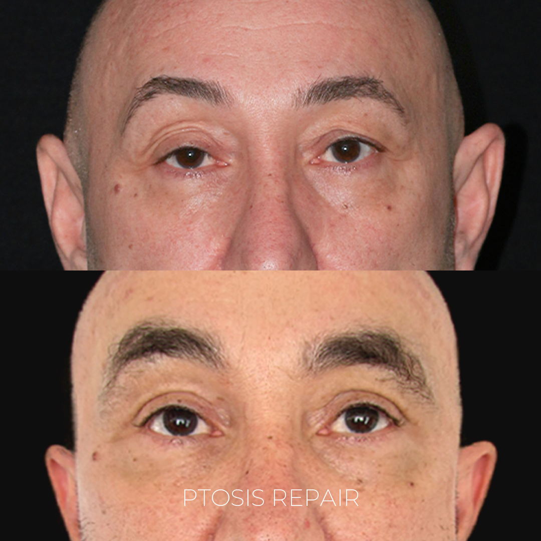Ptosis Repair