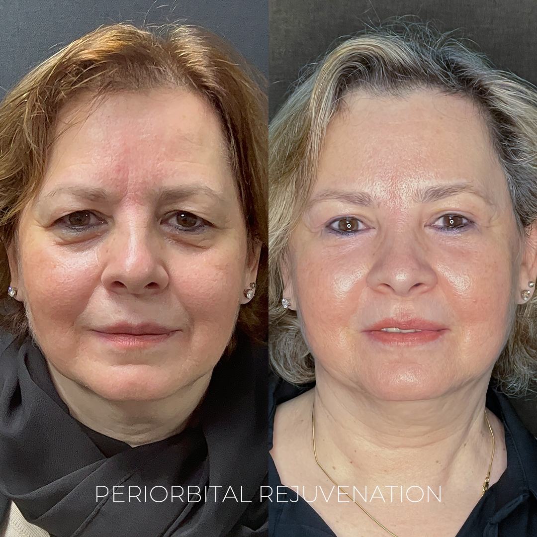 Periorbital Rejuvenation