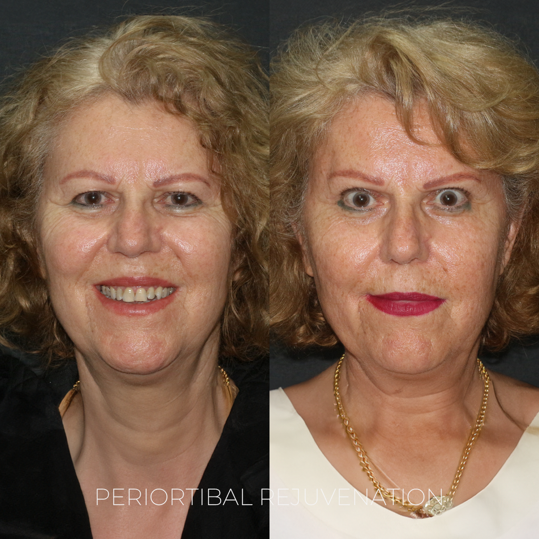 Periorbital Rejuvenation