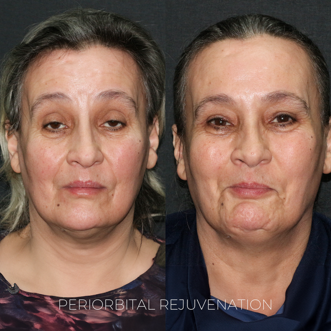 Periorbital Rejuvenation