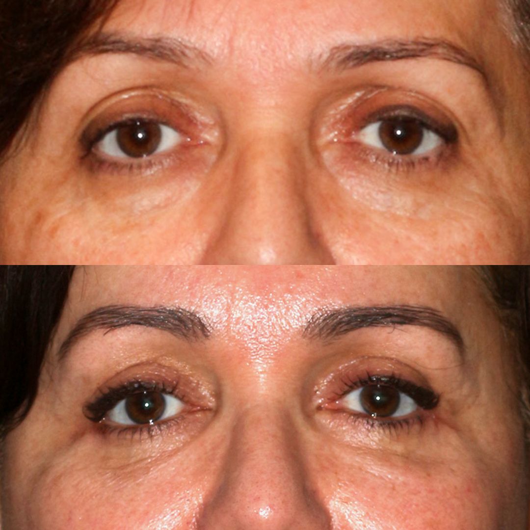 Blepharoplasty