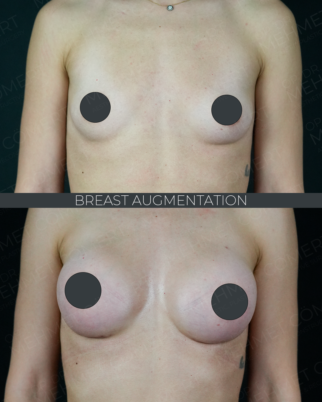 Breast Augmentation