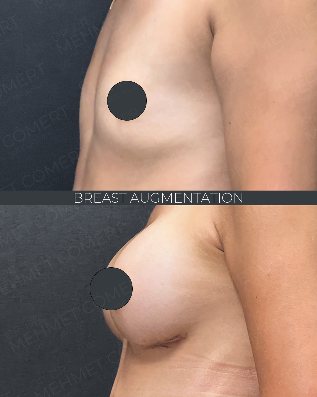 Breast Augmentation