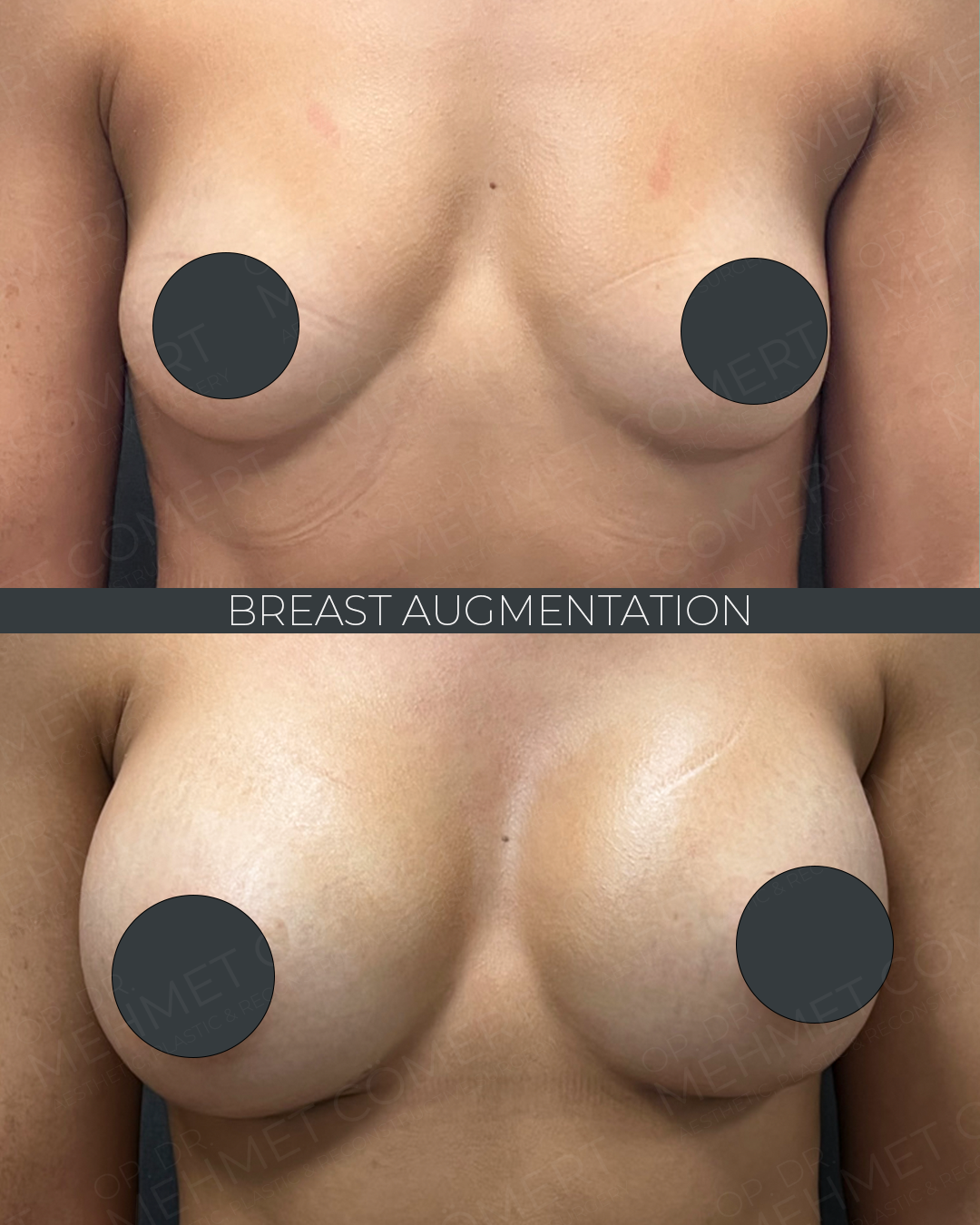 Breast Augmentation