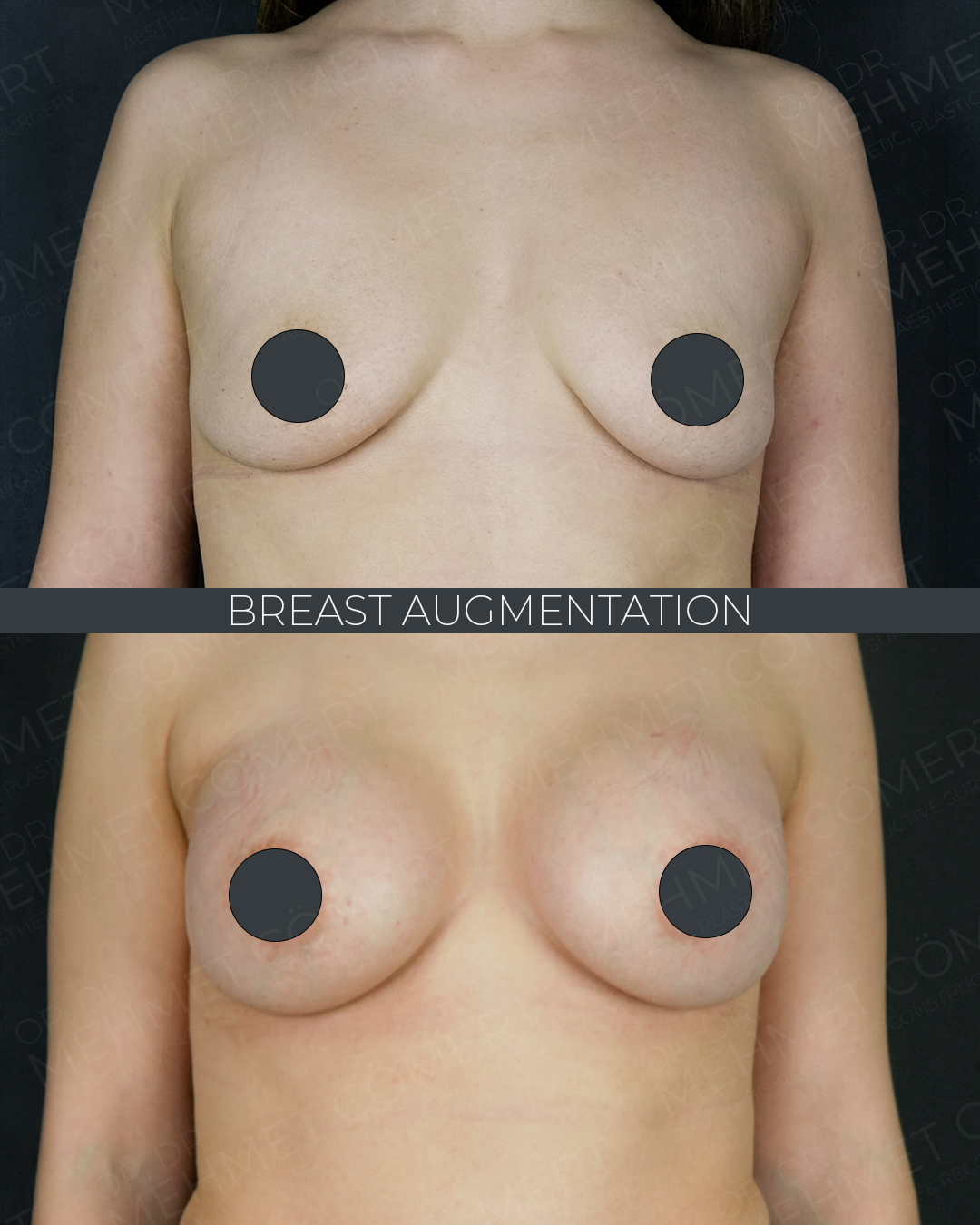 Breast Augmentation