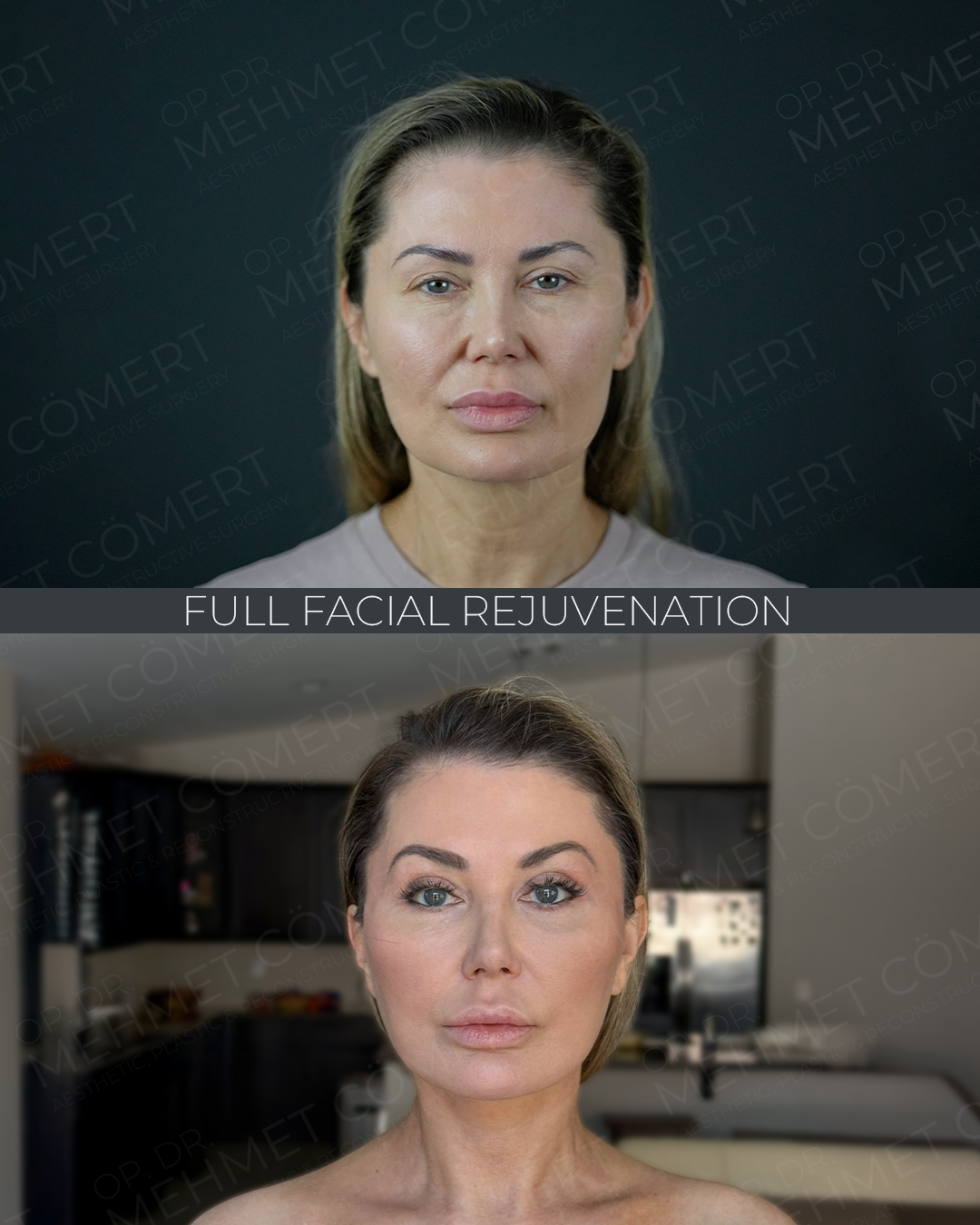 Facial Rejuvenation