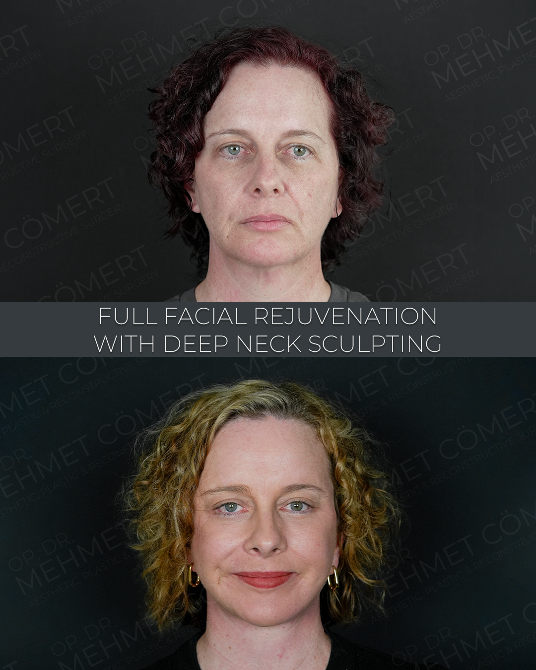 Full Facial Rejuvenation