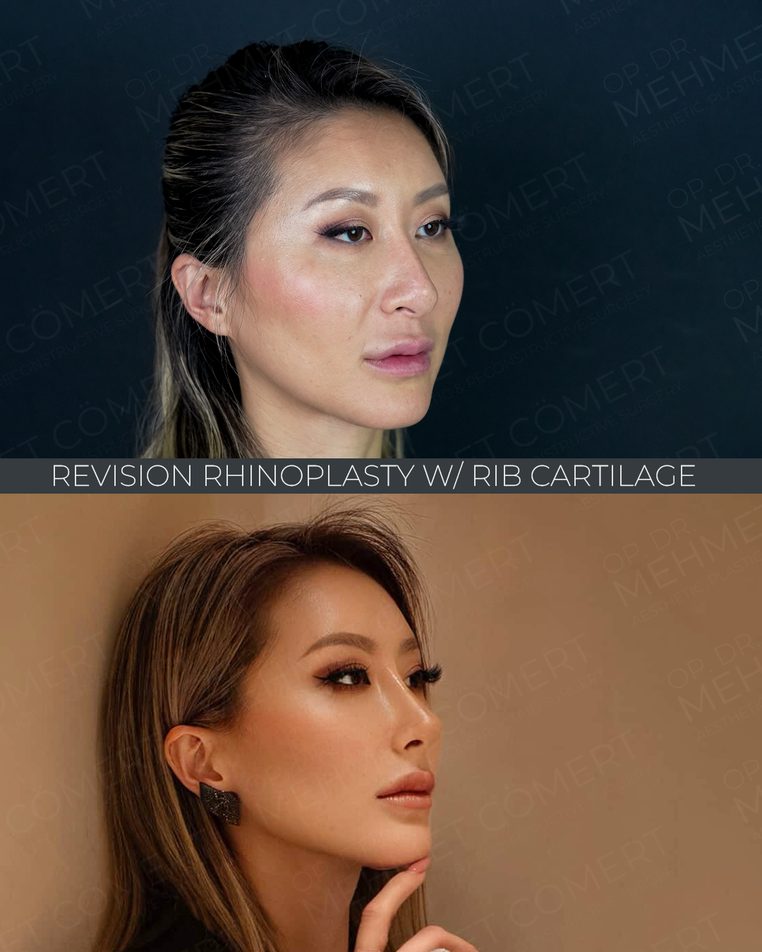 Revision Rhinoplasty