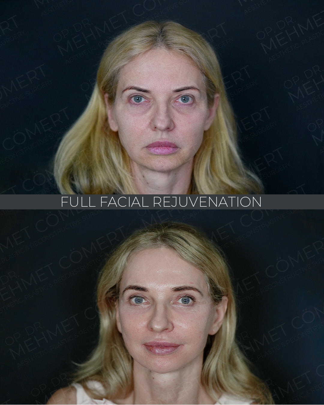 Full Facial Rejuvenation