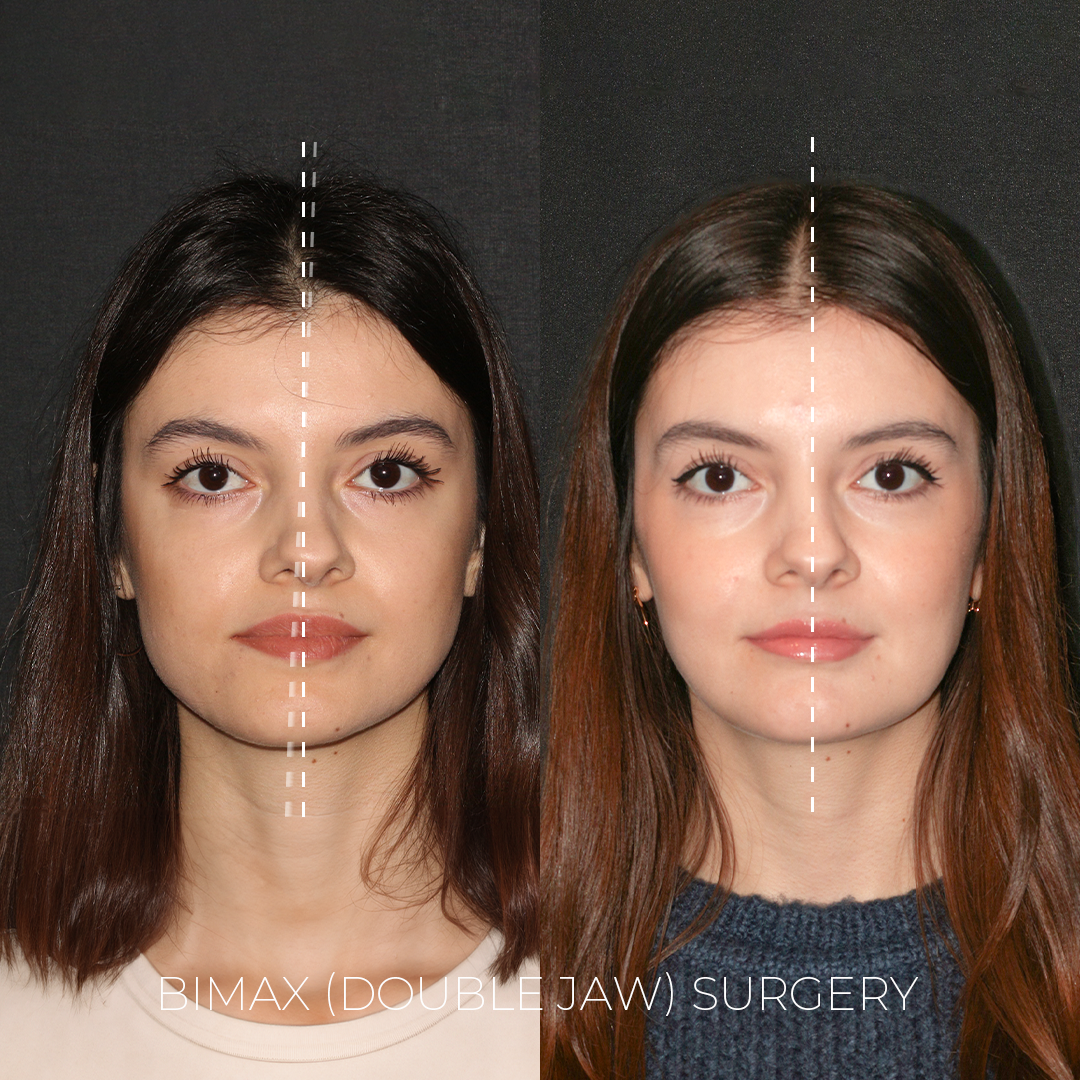 Bimax Surgery