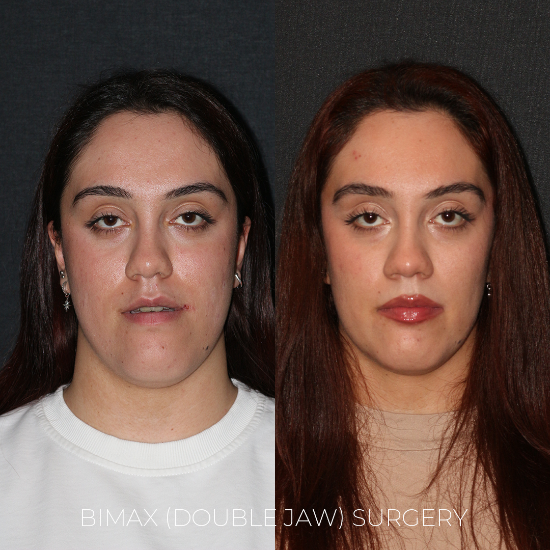 Bimax Surgery