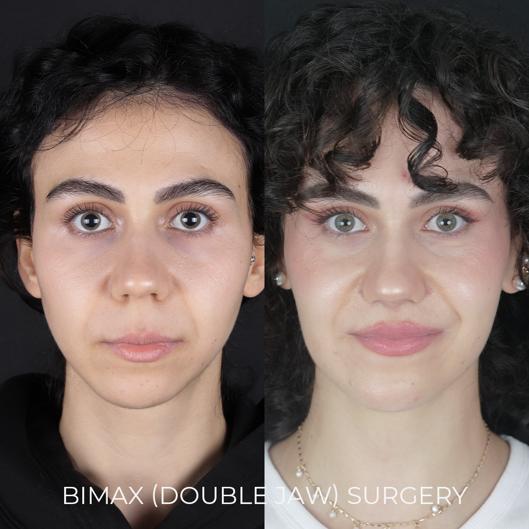 Bimax Surgery