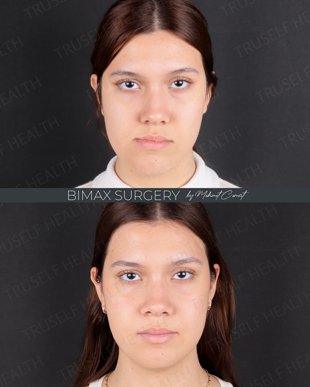 Orthognathic Surgery