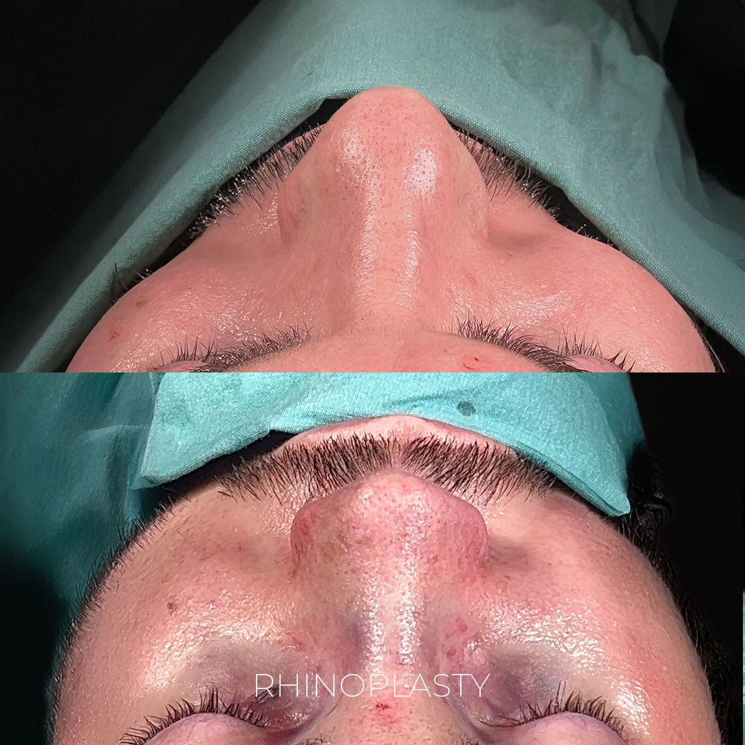 Rhinoplasty