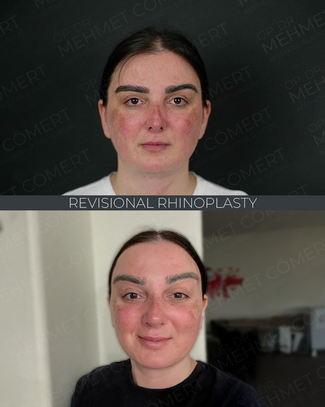 Revisional Rhinoplasty